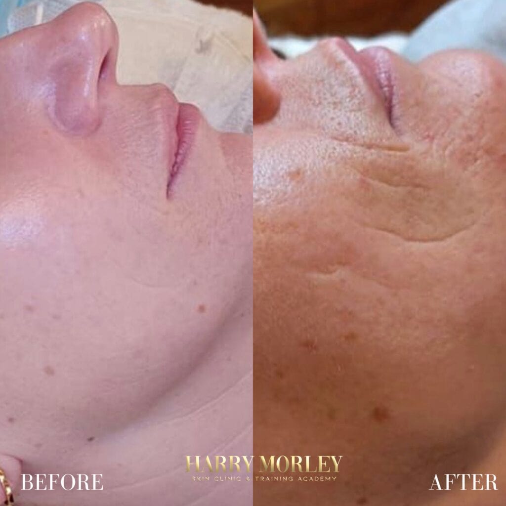 Anti-Ageing Treatment Results