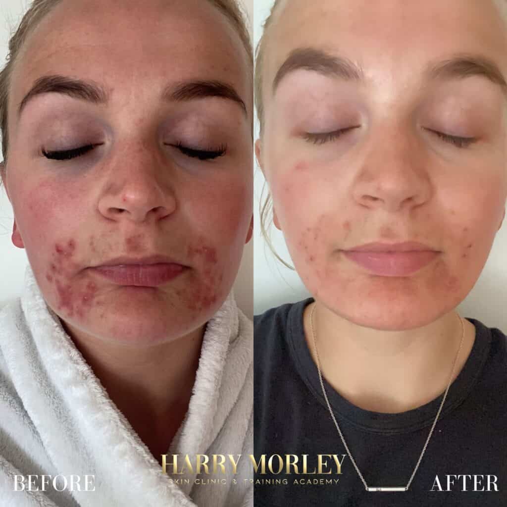 Results Of Harry Morley Mixologist Treatment