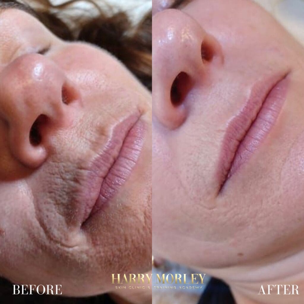 Results OF Harry Morley Anti-Ageing Treatments