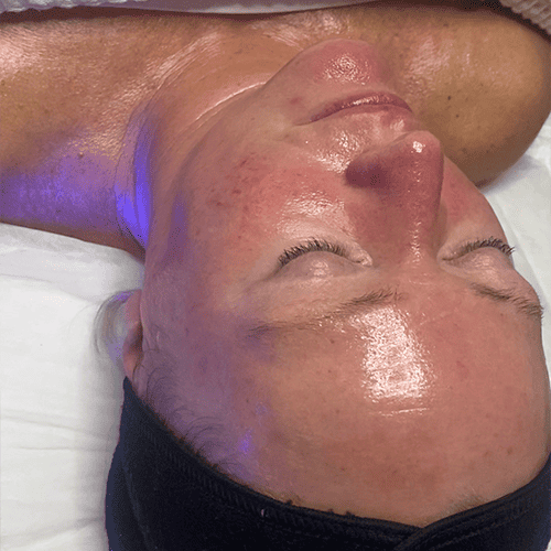 Hydrafacial By Harry Morley