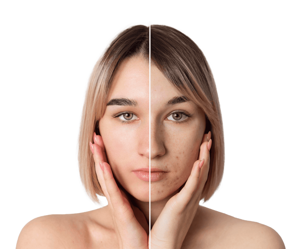 Skin Clinic Acne Treatments