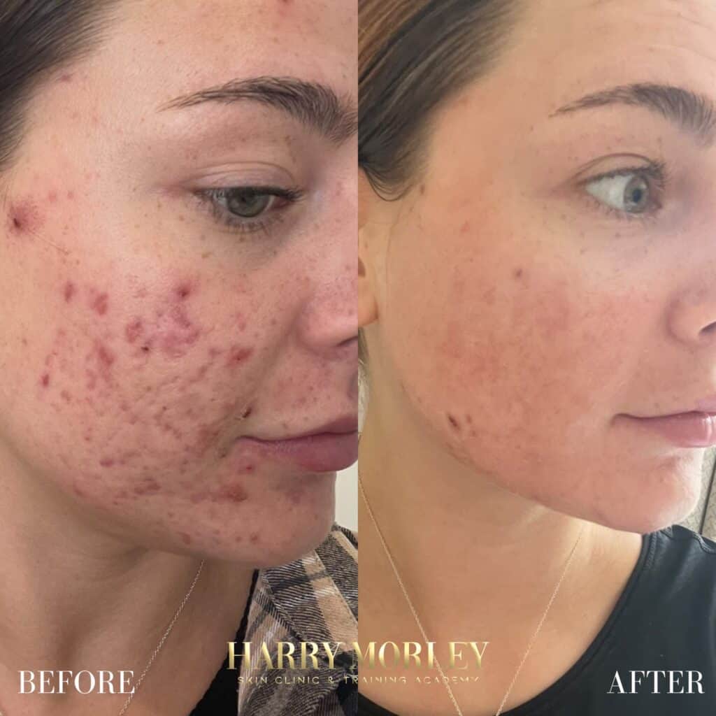 Acne Treatment Results By Harry Morley Skin Clinic