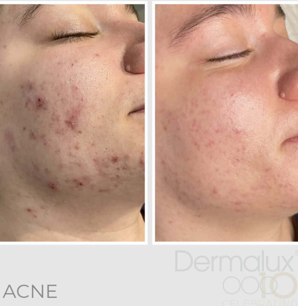 Amazing Dermalux Results