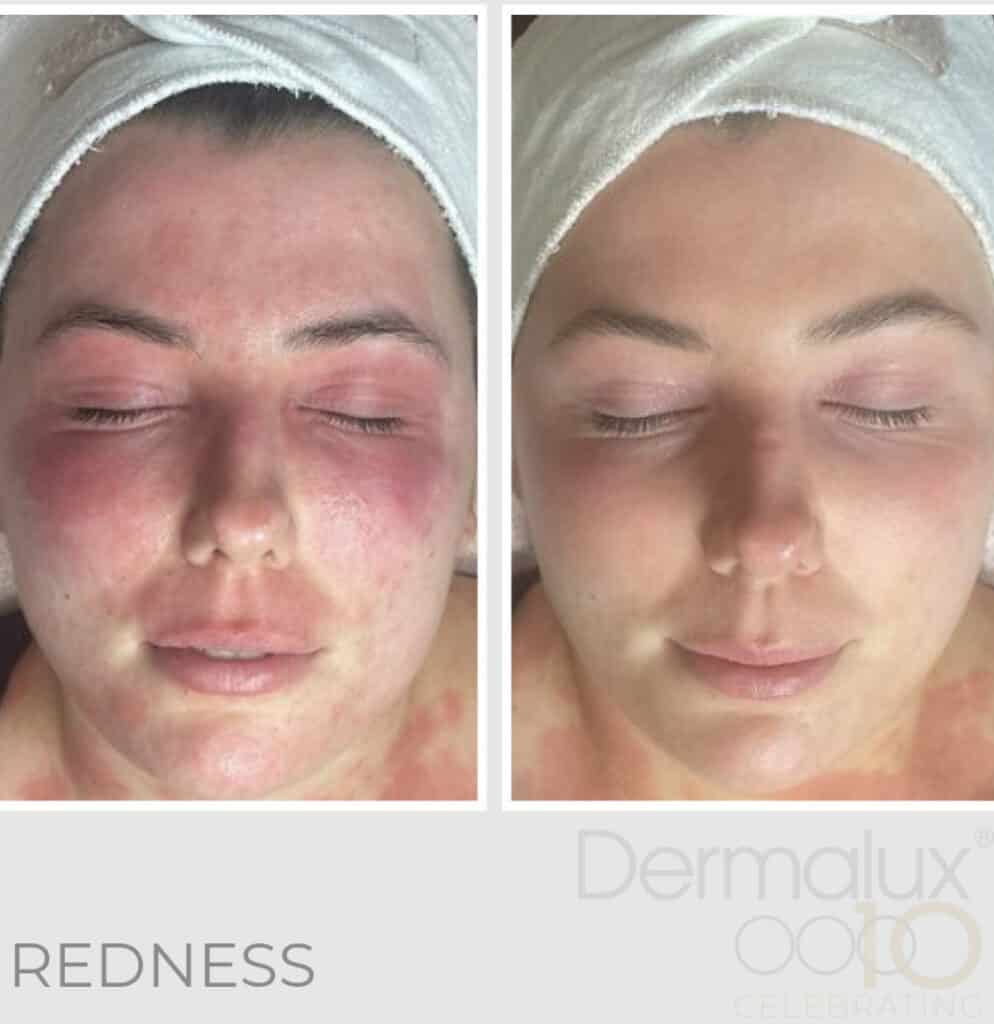 Dermalux Treatment Results