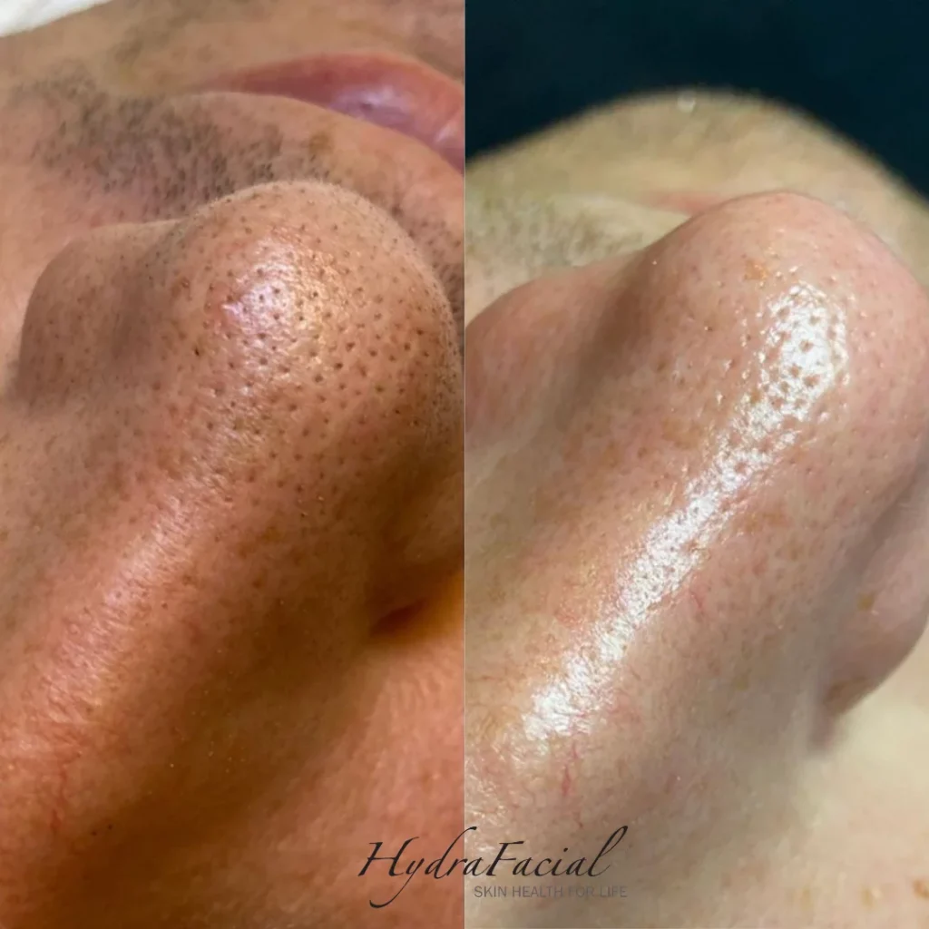 Nose and cheek pores before and after a Hydrafacial treatment