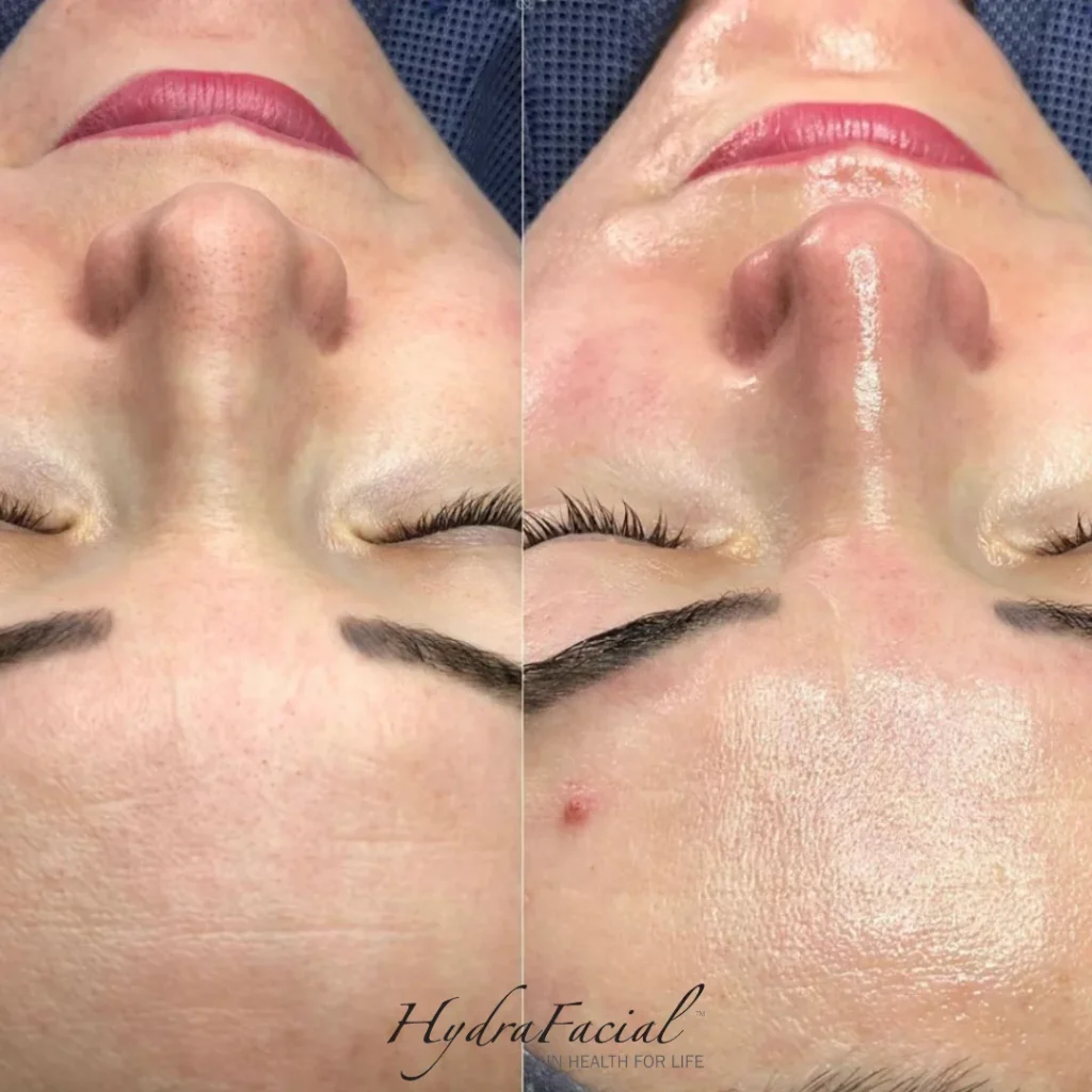 Skin before and after a Hydrafacial treatment