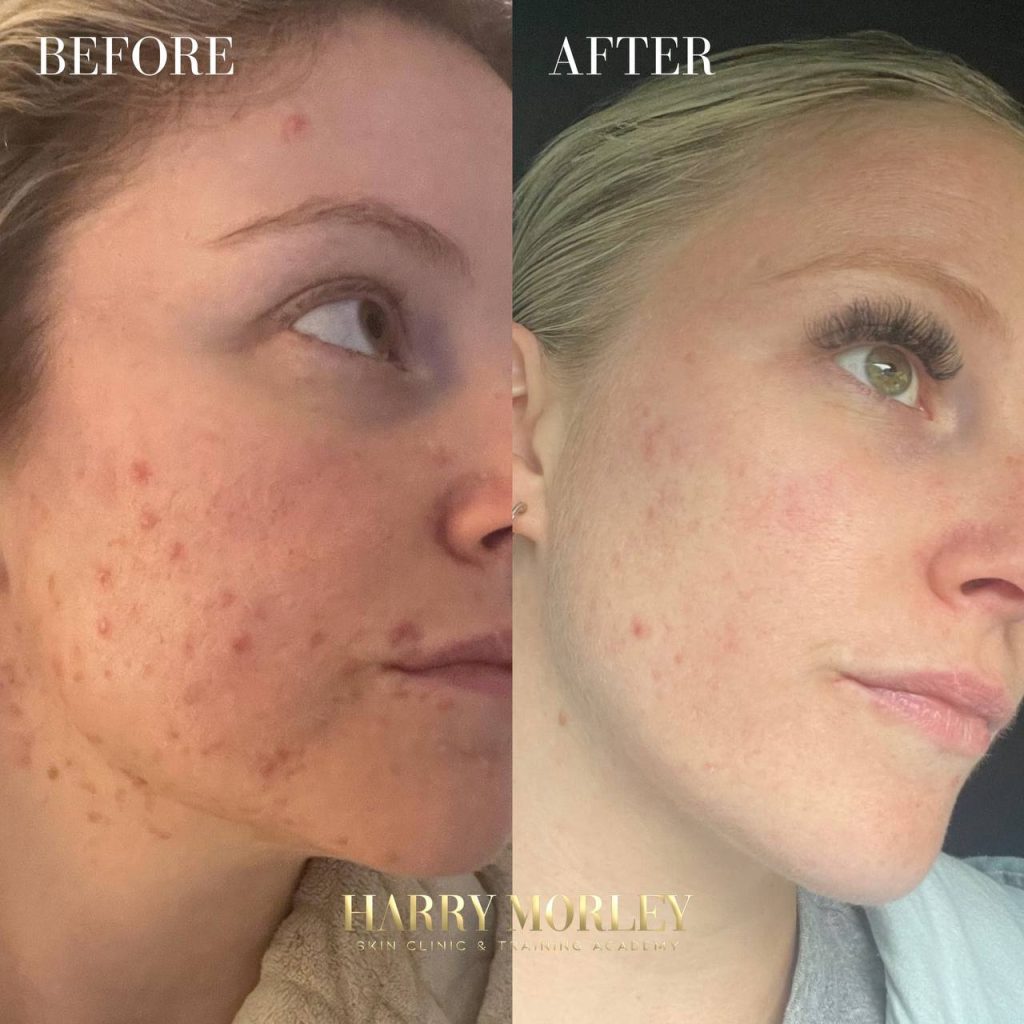 Cheek and jaw before and after a Green Peel treatment