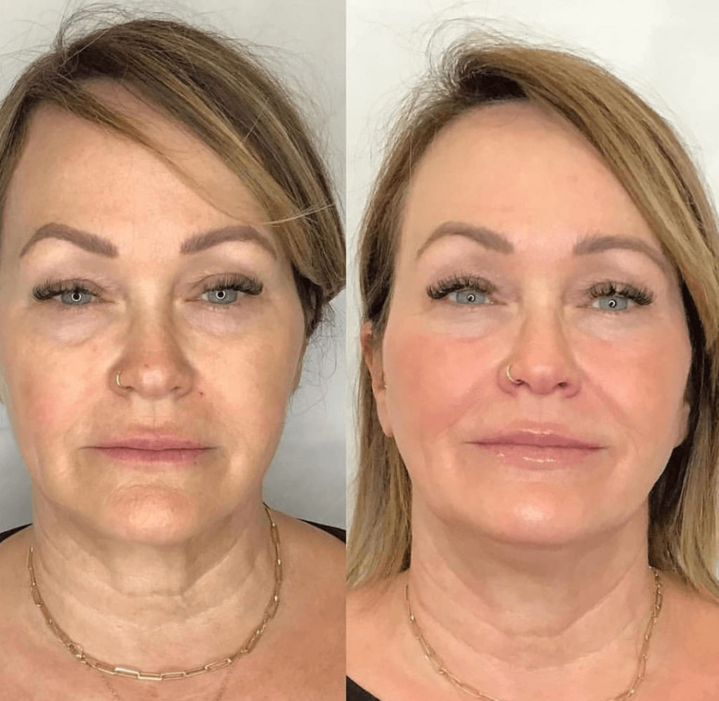 Front view of a face before and after a skincare programme