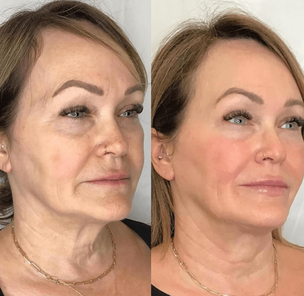 Three-quarter view of a face before and after a skincare programme