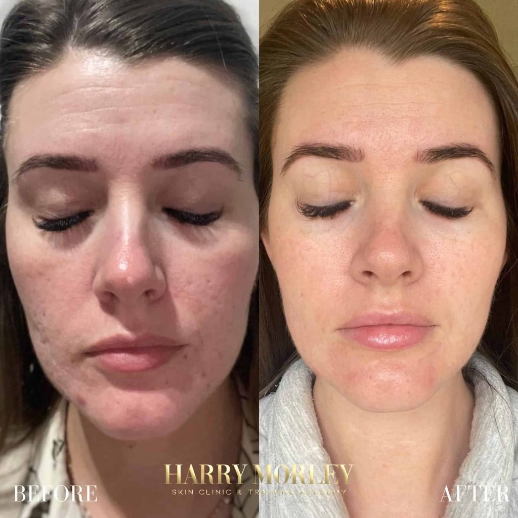 Full face before and after a TCA Peel