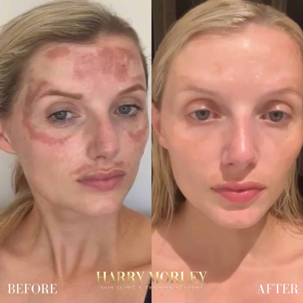 Face with patches of pigmentation before and after a Pigmentation Peel