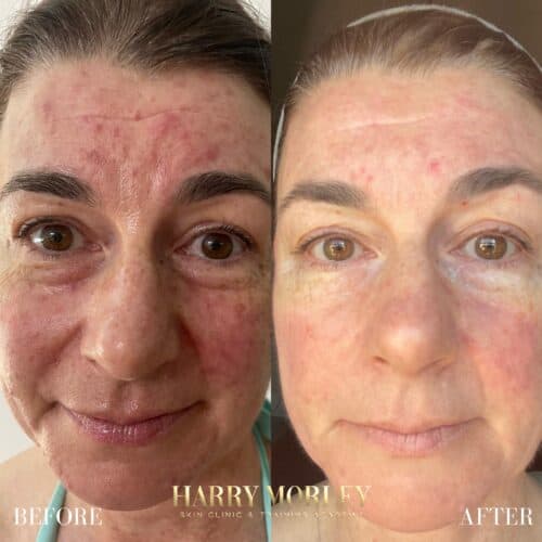 Redness across the cheeks and nose before and after a Rosacea Peel Treatment
