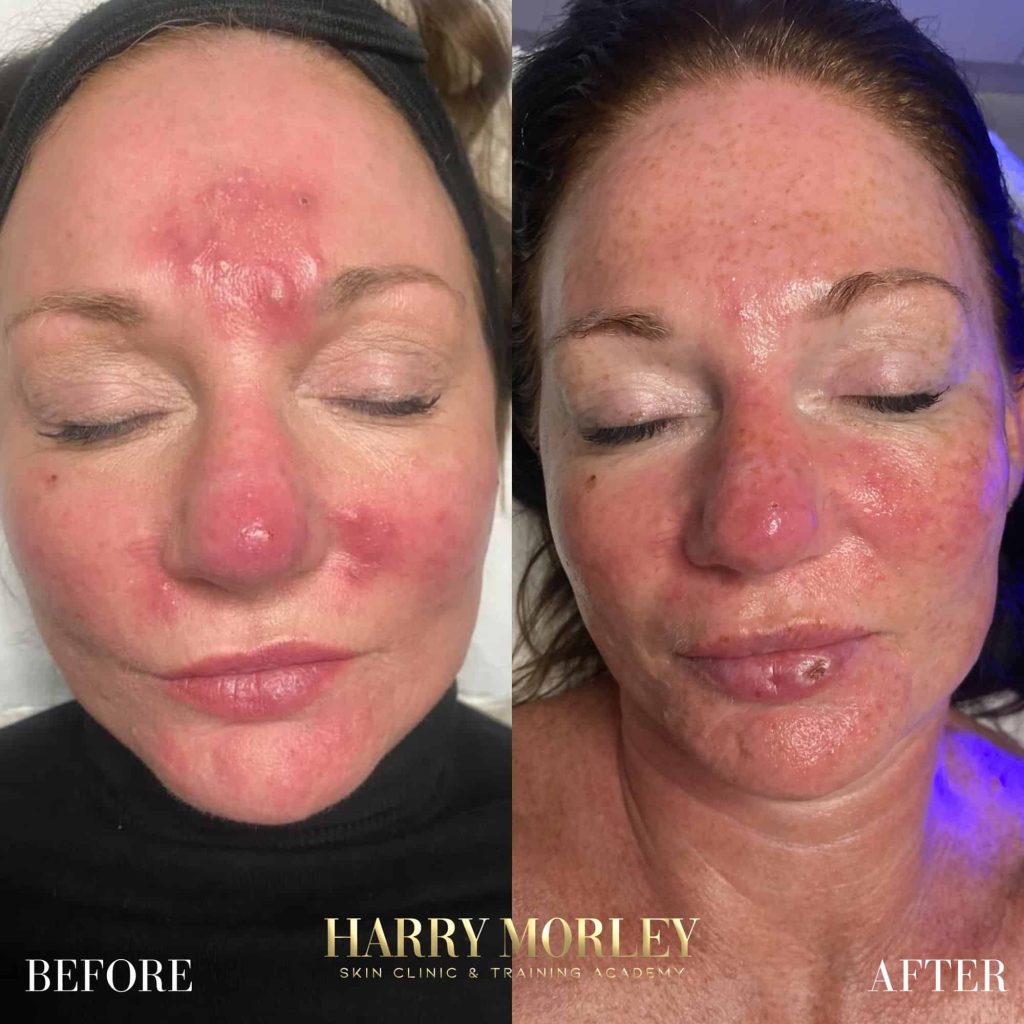 Inflamed, red facial skin before and after an Acne Extreme treatment