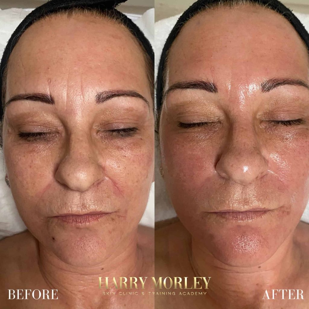 Mature skin before and after a TCA Peel