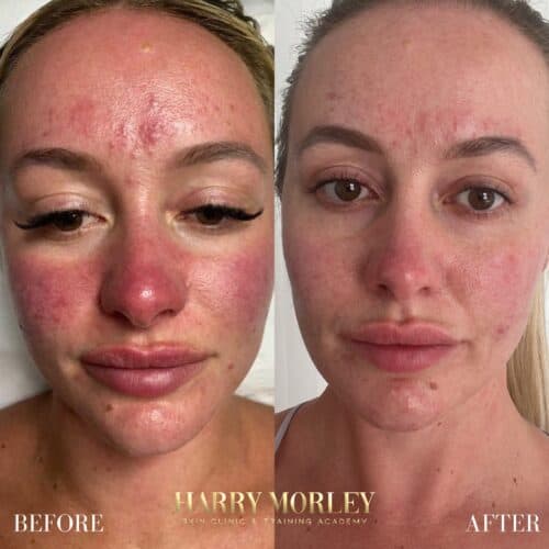 Facial redness before and after a Rosacea Peel Treatment
