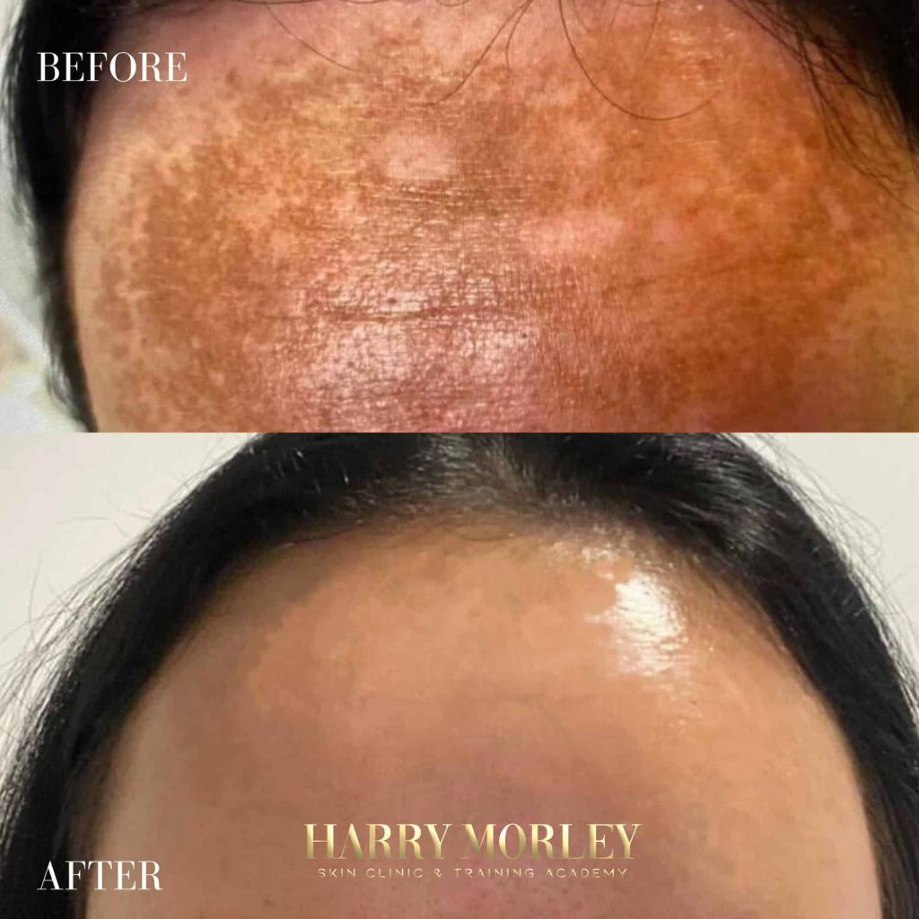 Forehead pigmentation before and after a Pigmentation Peel