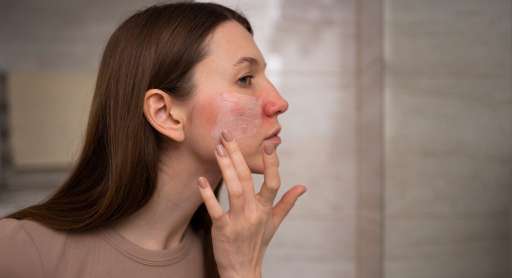 Rosacea Peel Treatment