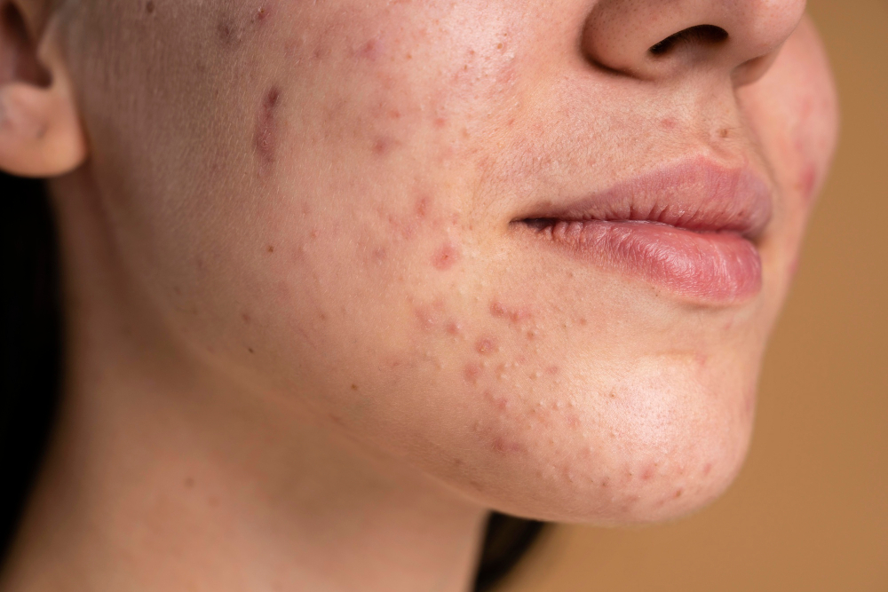 Acne Masterclass