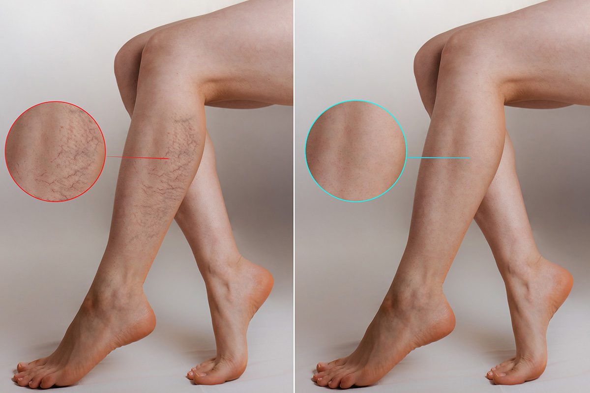 Red-vein-laser-removal-london-Harley-Street