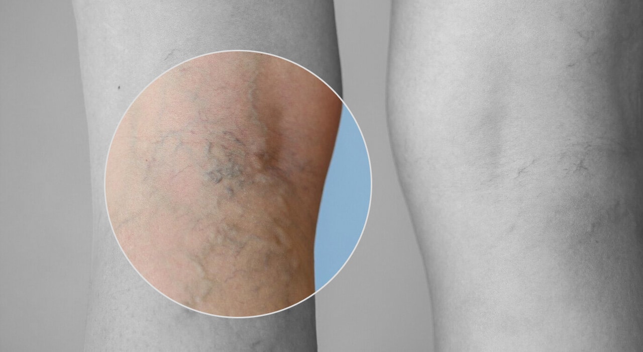 thread veins