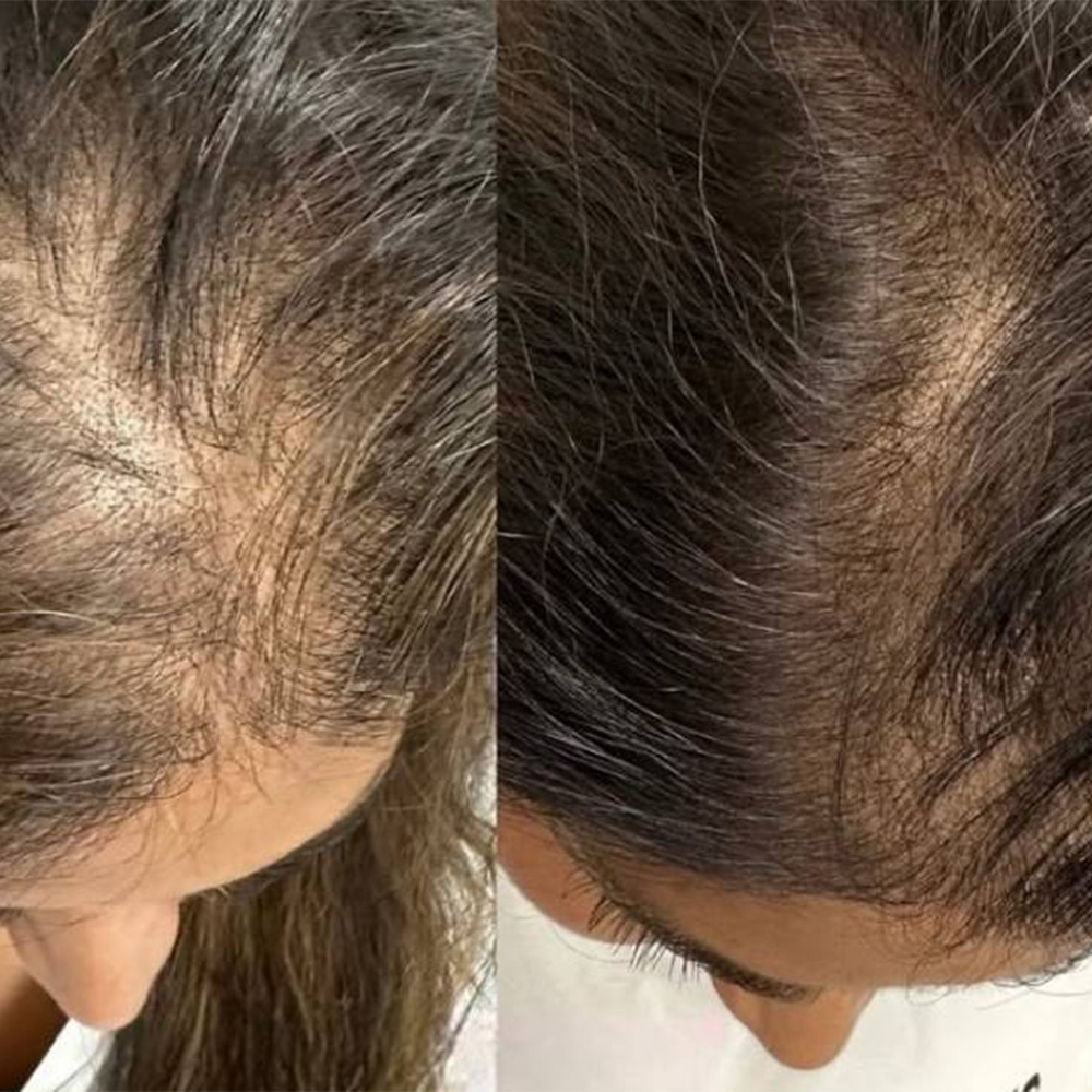 Injectables 16 Hair density before and after hair restoration treatment by Dr Abes Nassiri