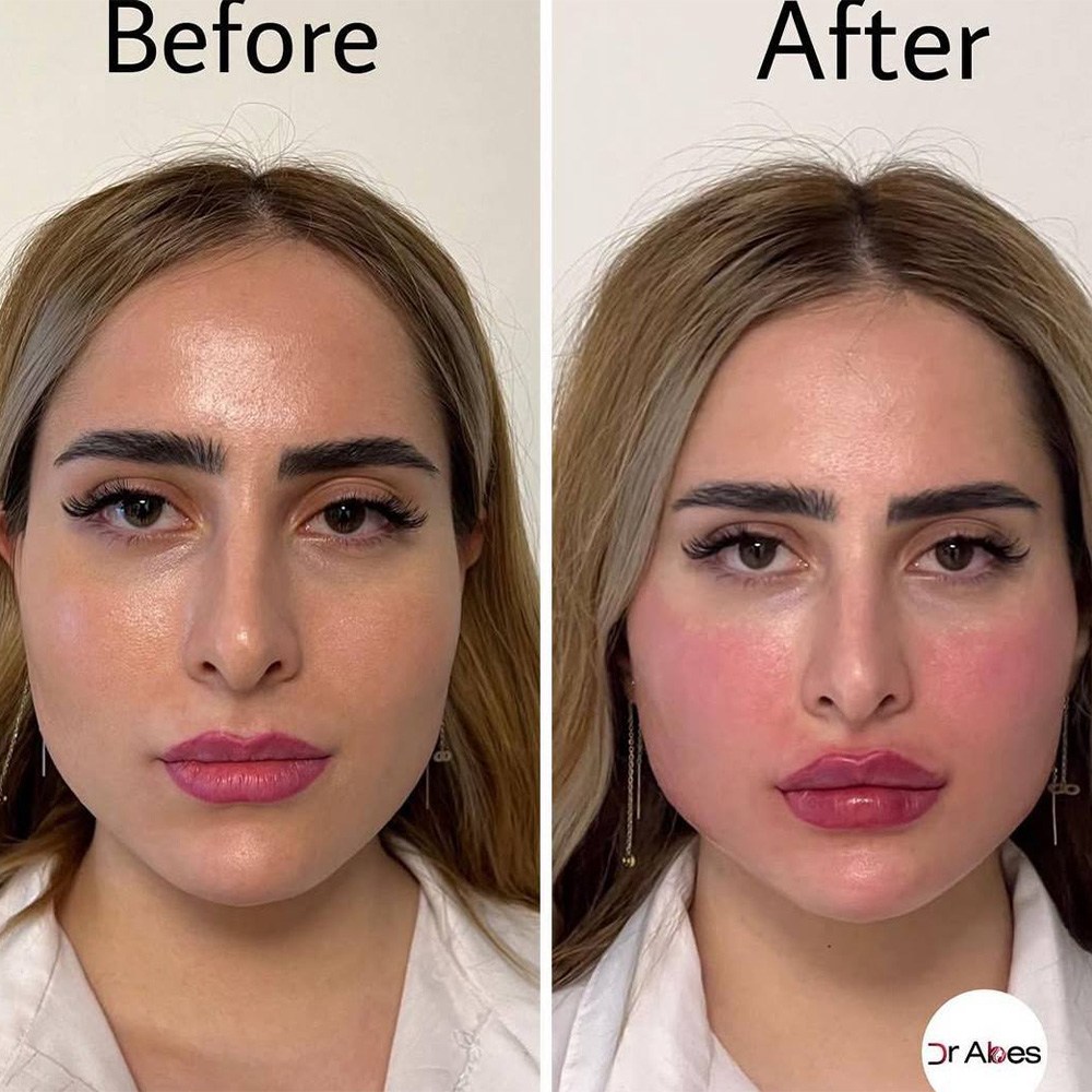 Face before and after lip and cheek filler by Dr Abes Nassiri