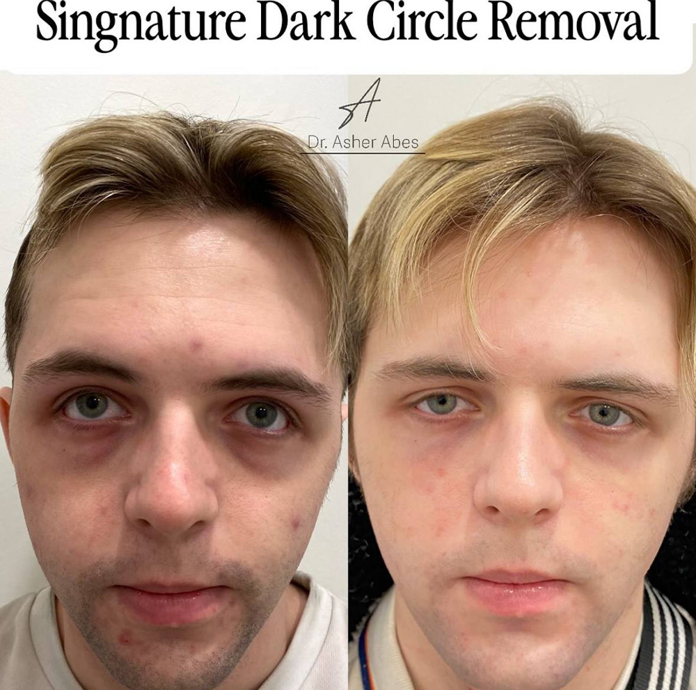 Full Face Harmonisation 8 Dark circles before and after Dr Abes’ signature dark circle treatment