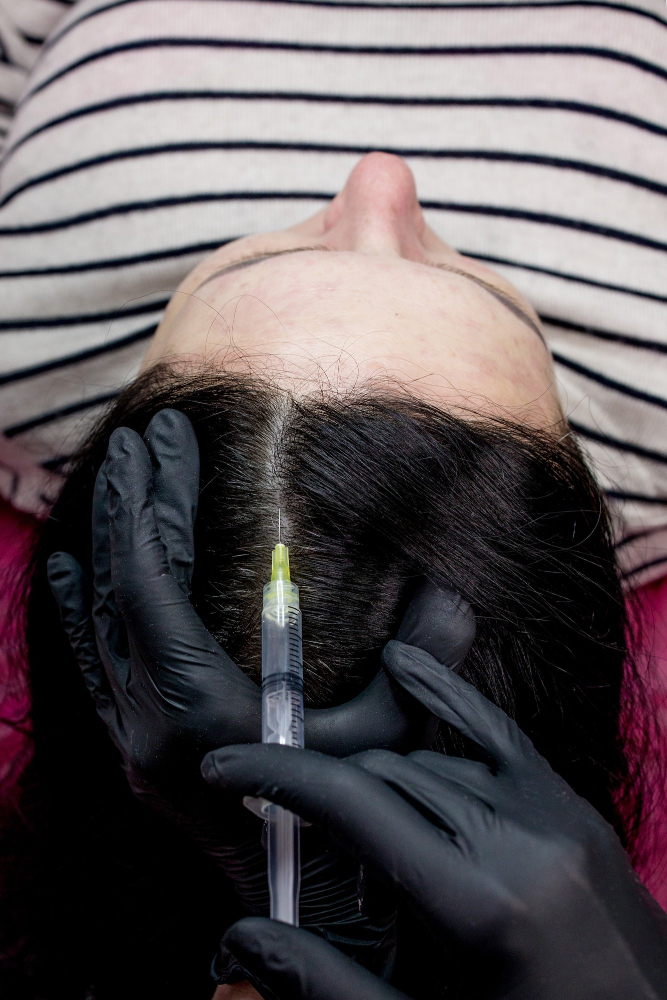 PRP Hair Restoration 2 PRP Hair Restoration