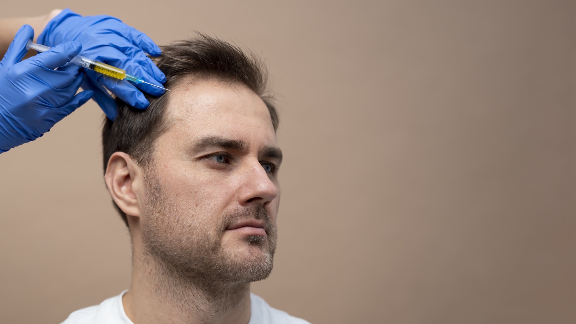 PRP Hair Restoration 1 Man receiving a PRP scalp treatment for thinning hair